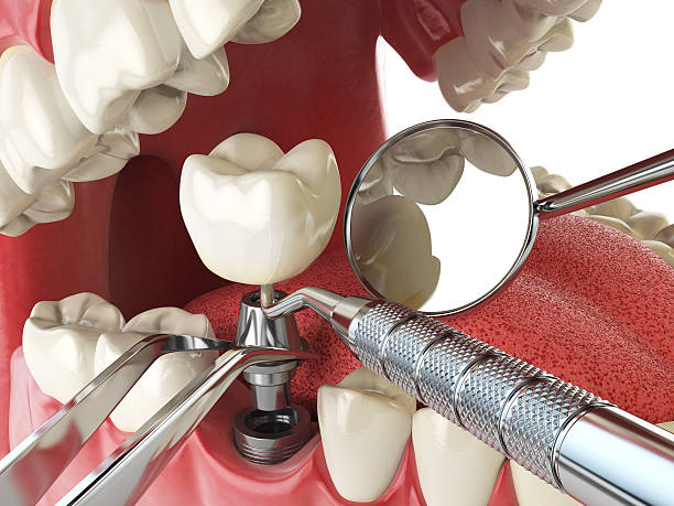Best Emergency Wisdom Teeth Removal in Guernsey, WY